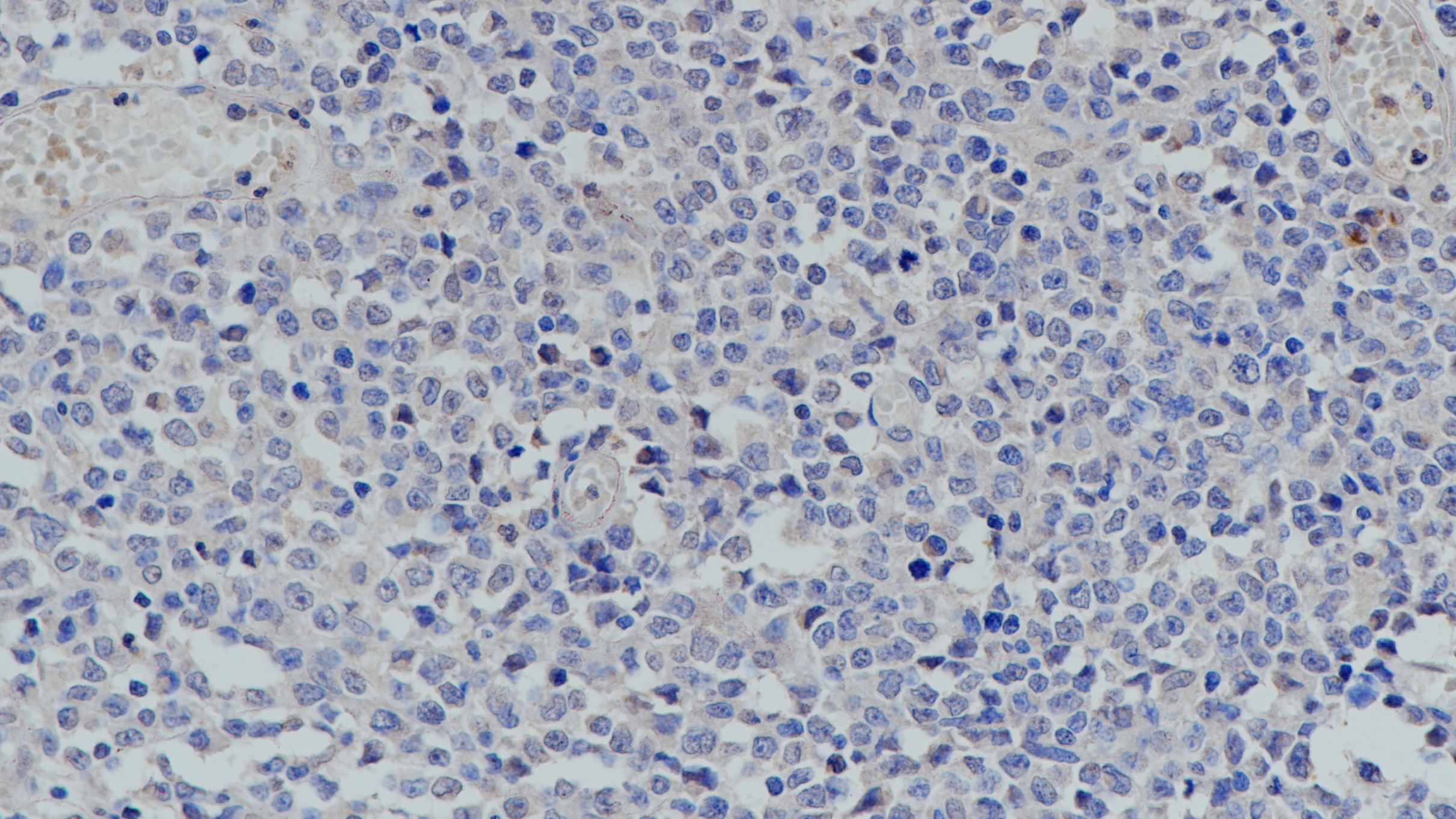 Calretinin(poly)彌漫大B細(xì)胞淋巴瘤 陰性組織染色