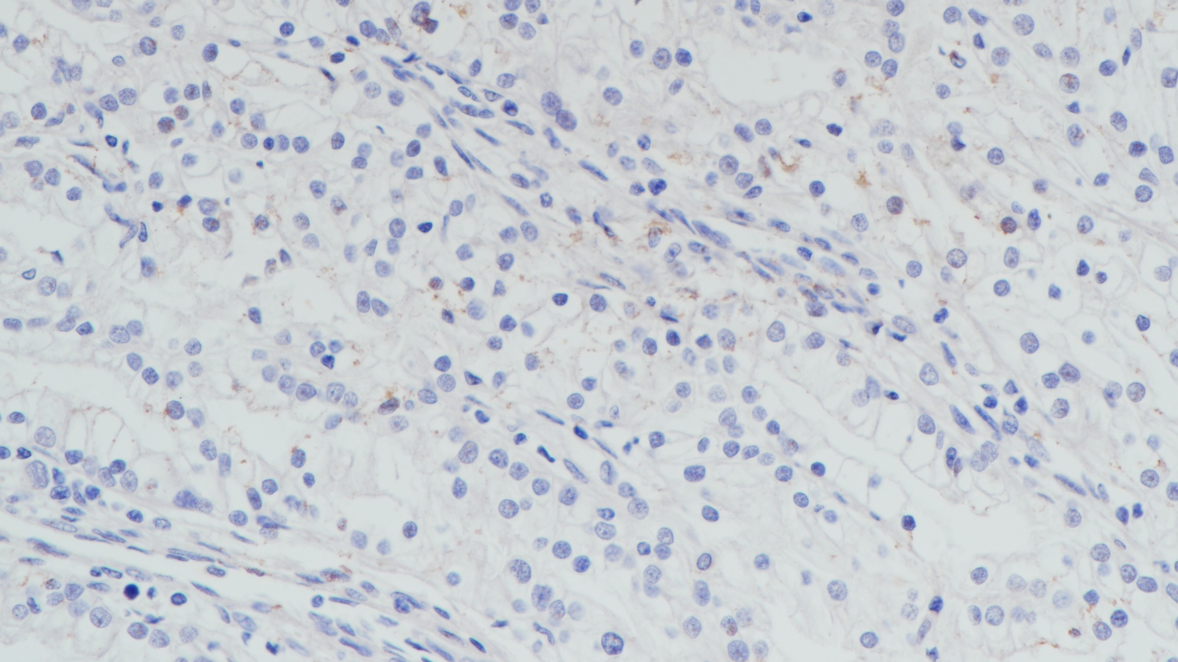 腎透明細(xì)胞癌TFE3(BP6180)染色