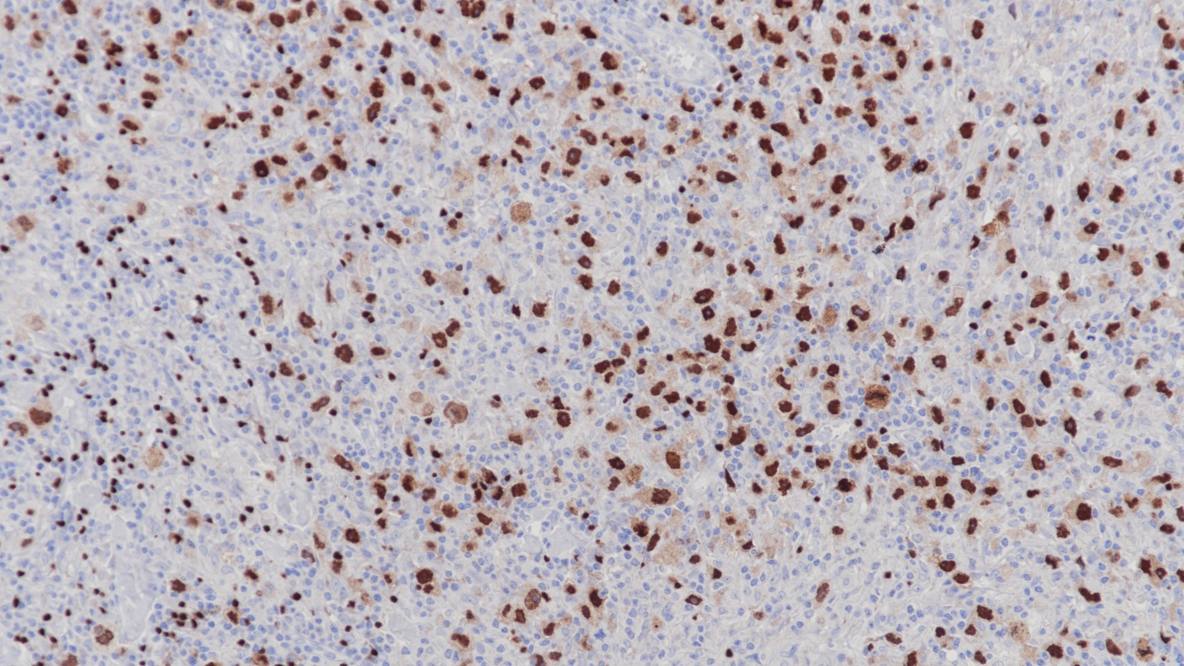 經(jīng)典型霍奇金淋巴瘤Pax-5(BP6140)染色