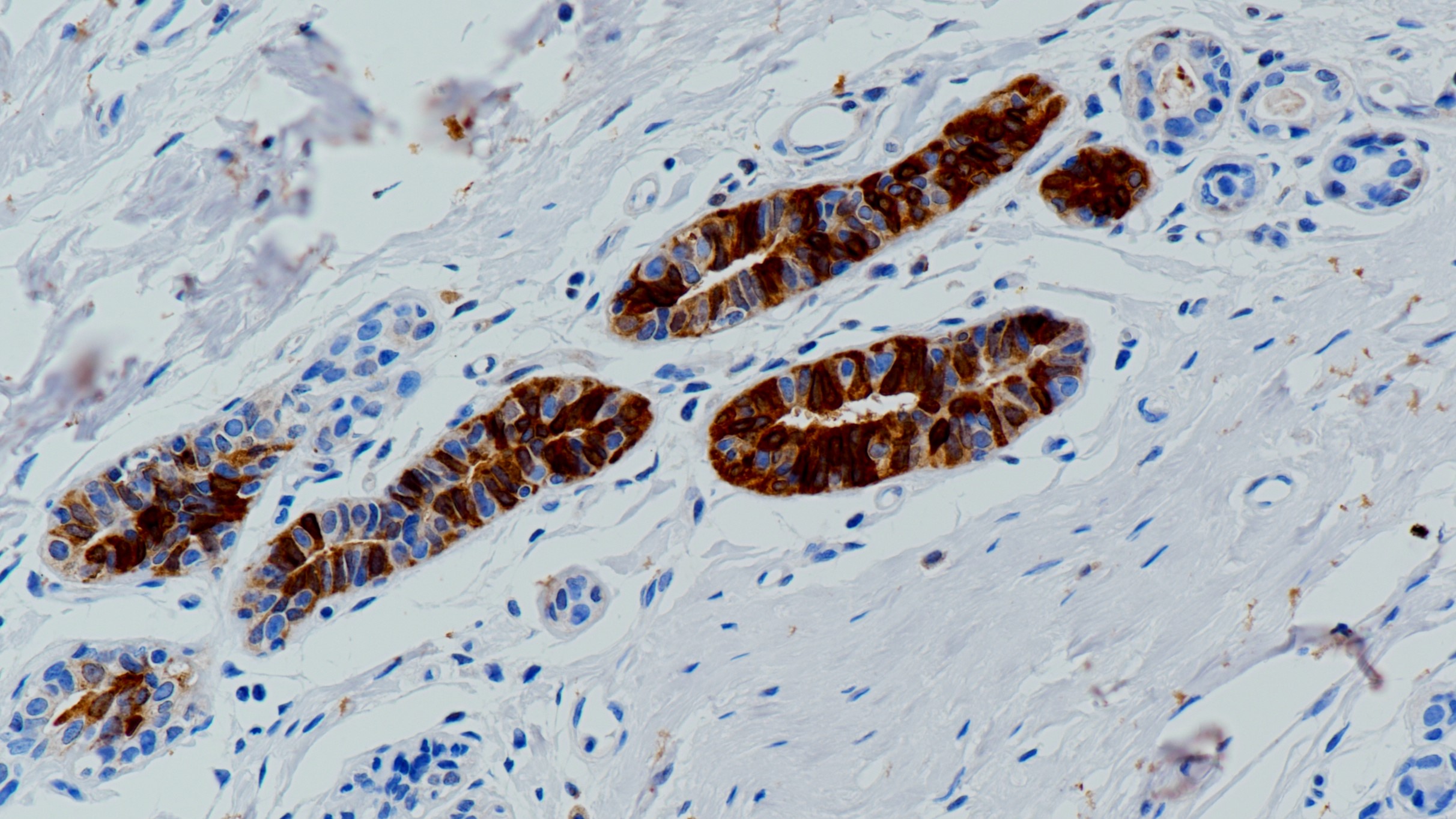 乳腺M(fèi)ammaglobin(BP6125)染色.jpg