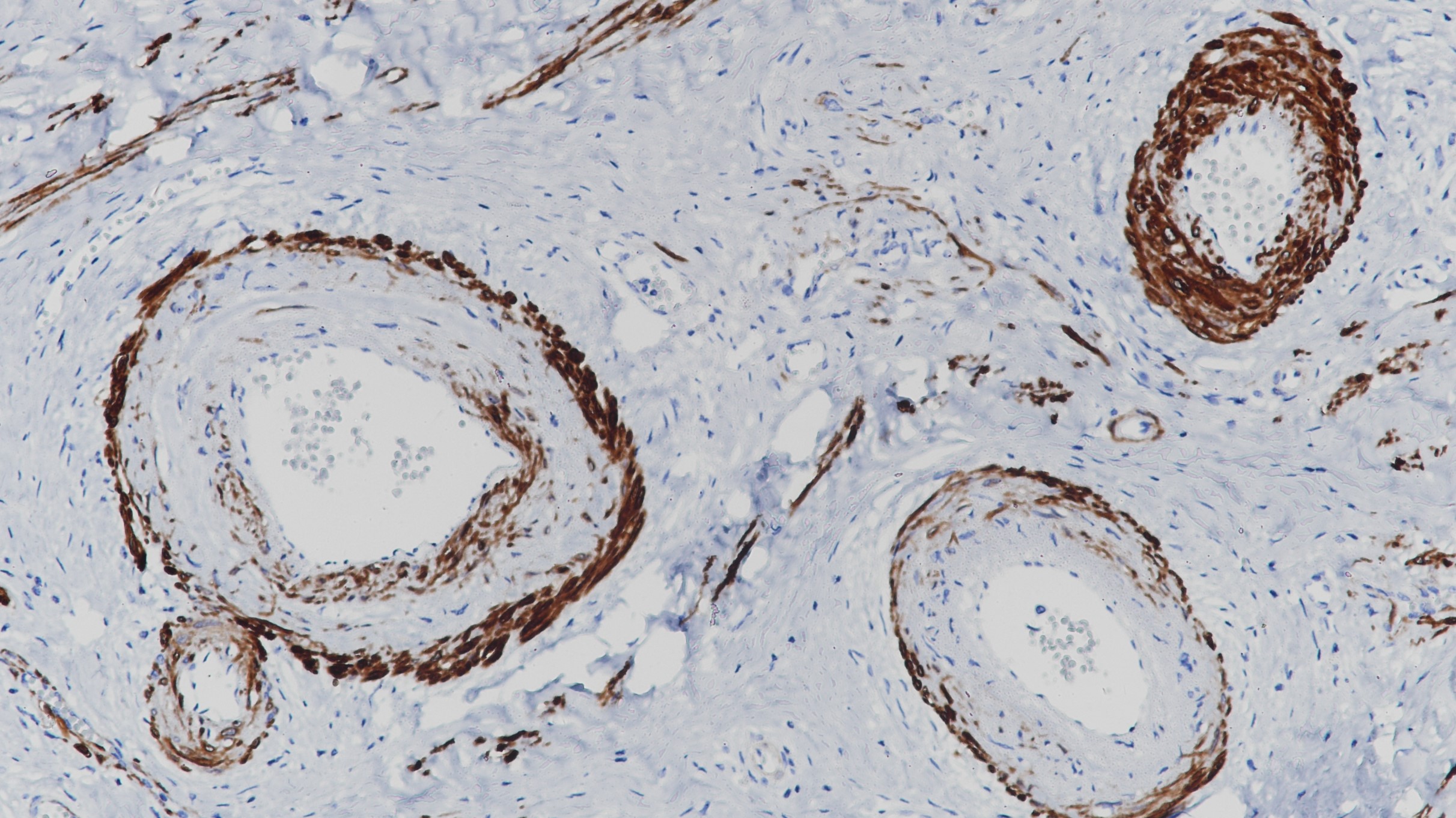 宮頸Calponin(BP6093)染色