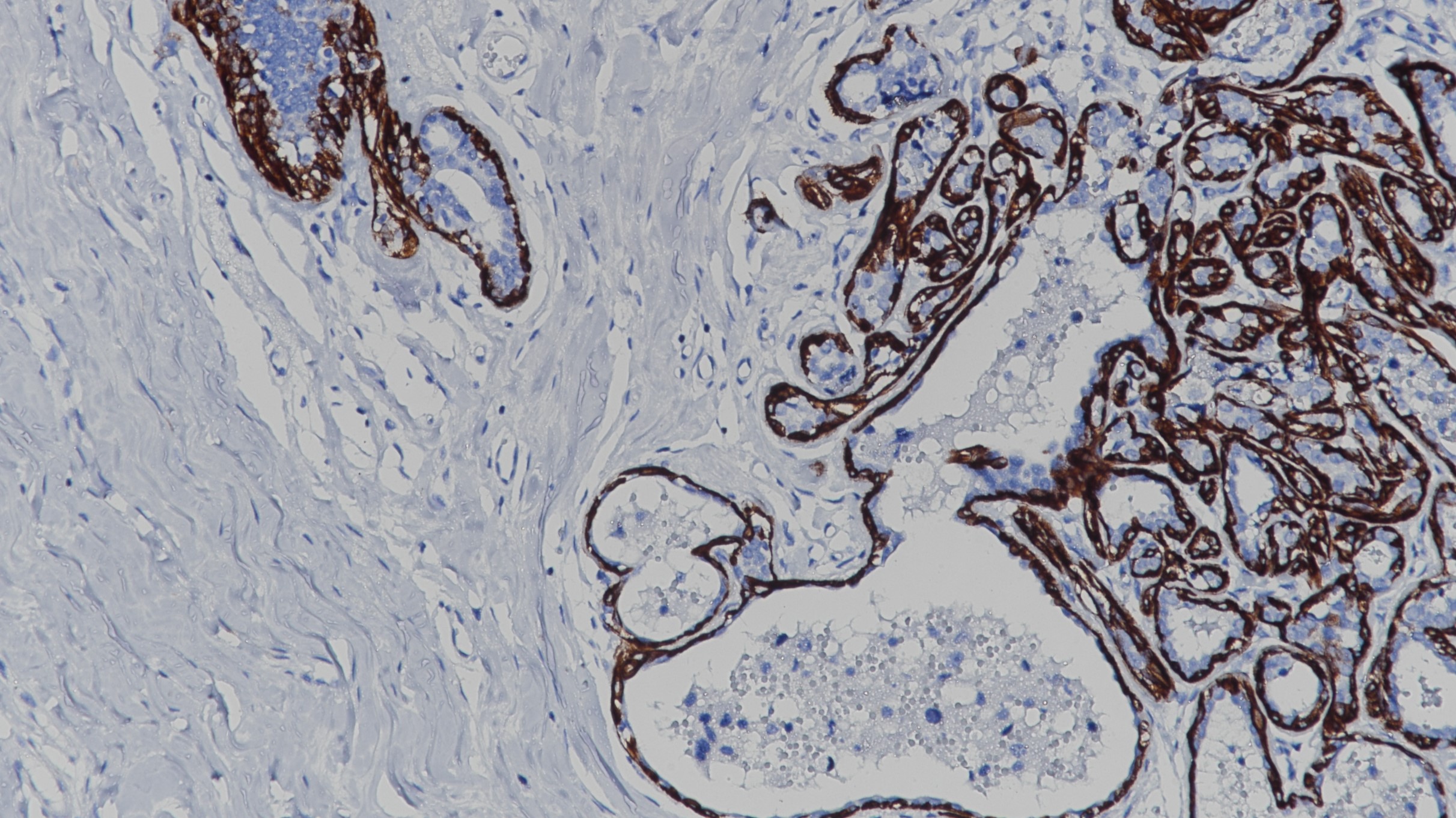 乳腺癌Calponin(BP6093)染色