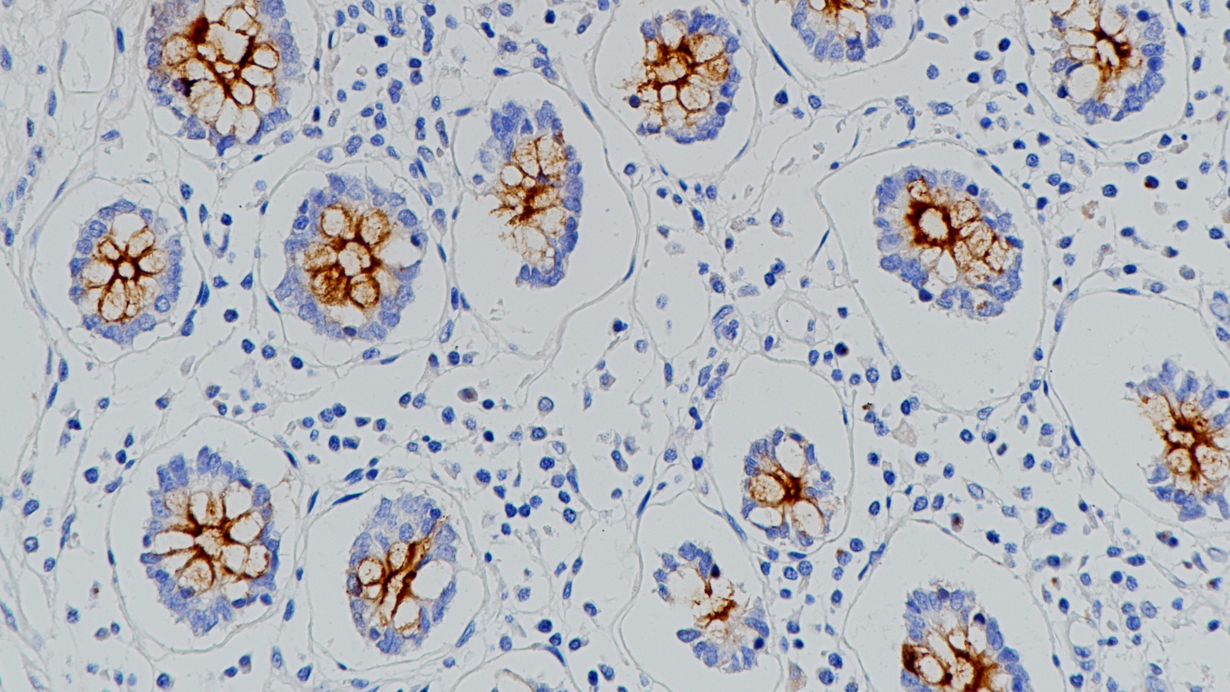結(jié)腸MUC1(BP6034)染色