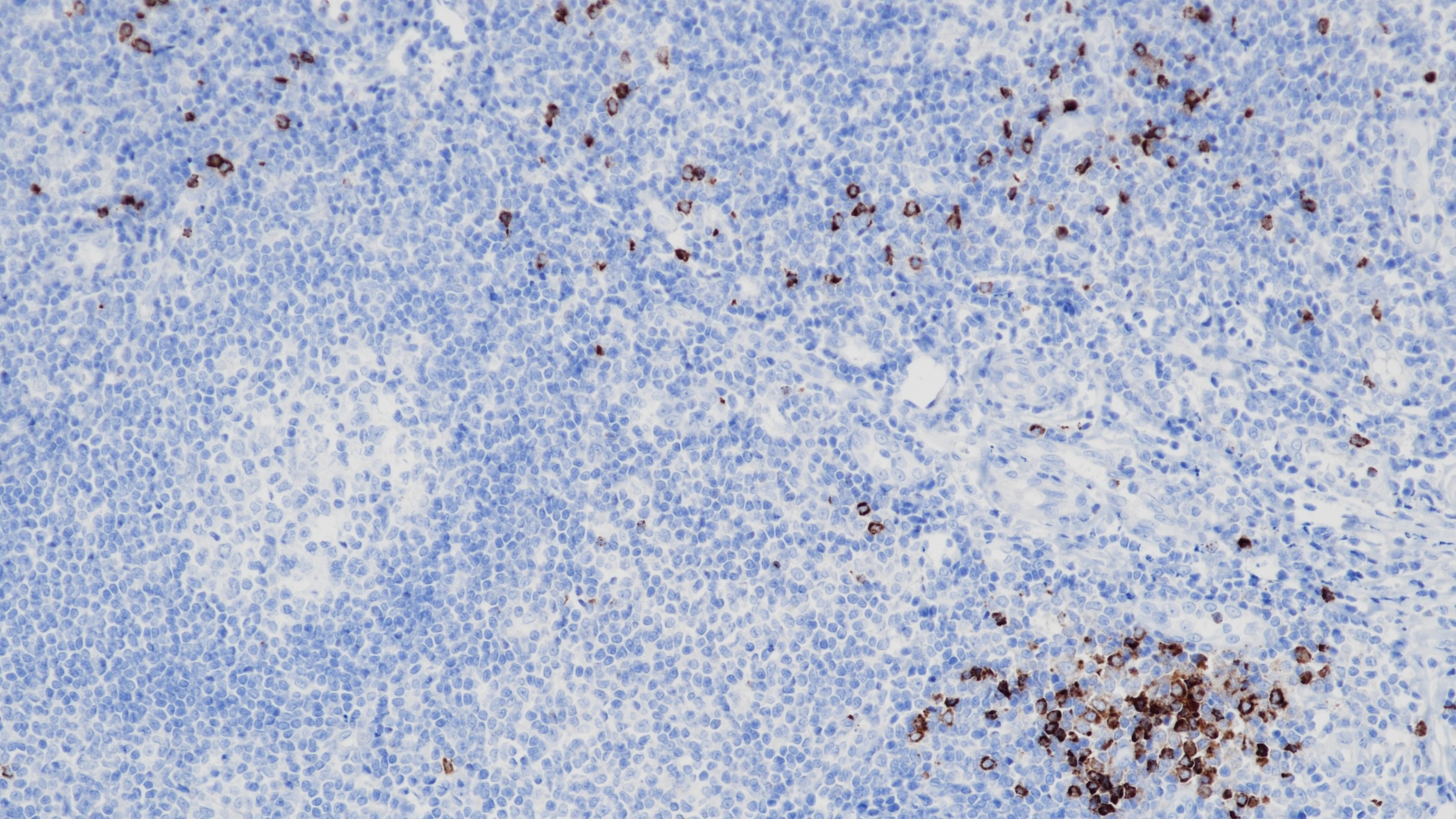 扁桃體Granzyme B(BP6029)染色2