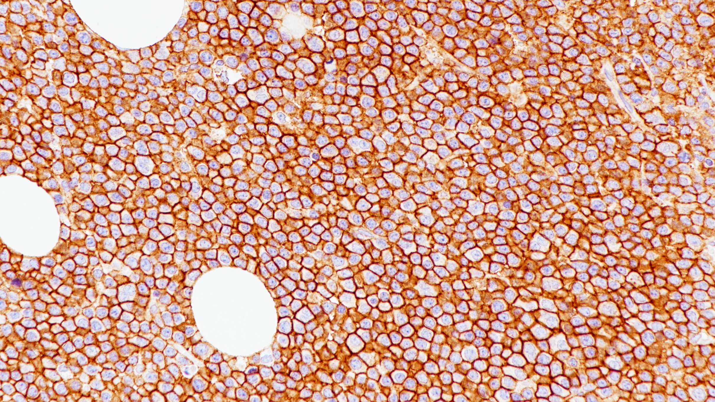 漿細胞瘤CD138(BP6035)染色