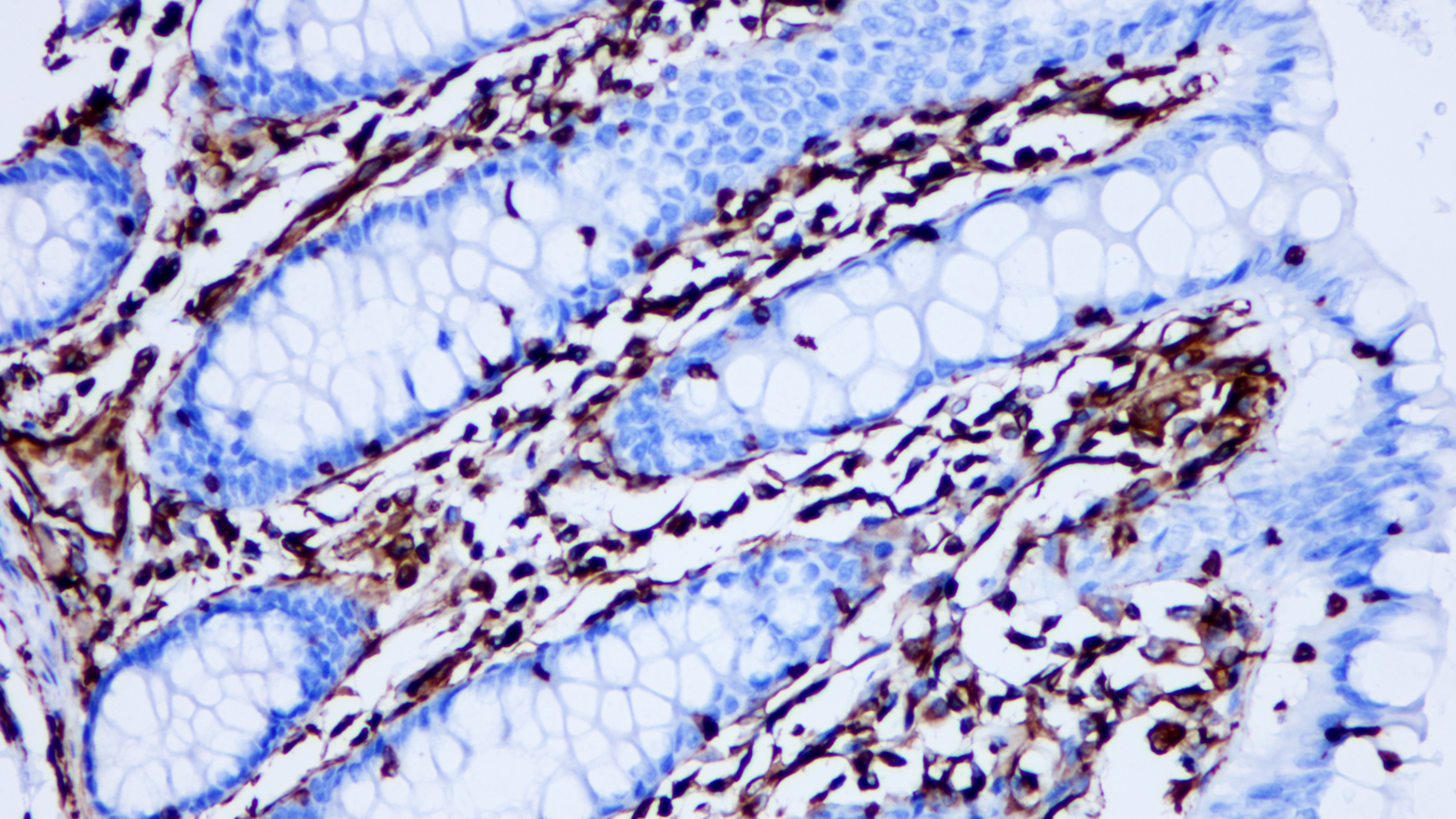 結(jié)腸Vimentin(BP6010)染色